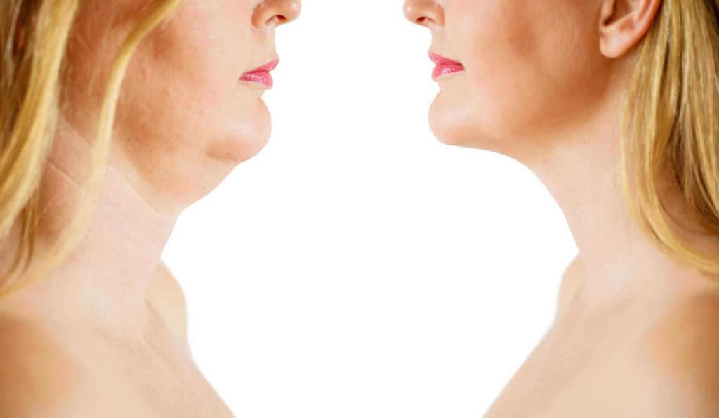 Double Chin treatment Kirkstall before and after results