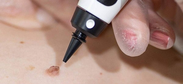 After Skin Tag Removal Kirkstall