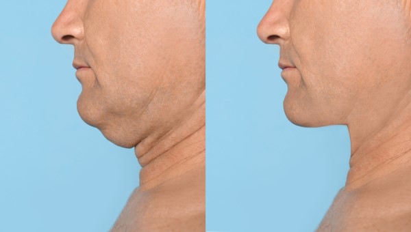 Which Non-Surgical Treatments Work Best for Jowls and Loose Skin Kirkstall?