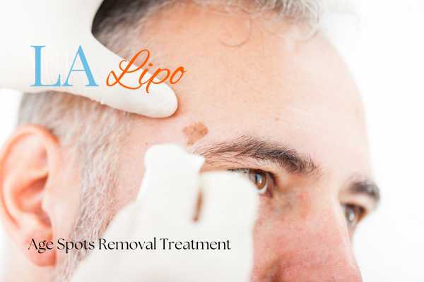 What Are the Most Effective Treatments for Age Spots Kirkstall?