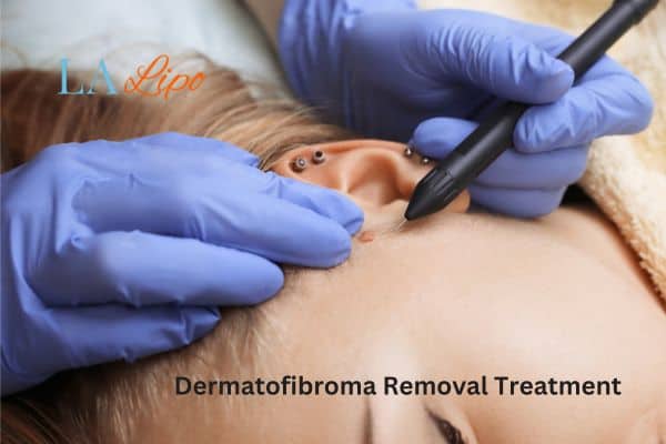 Dermatofibroma Removal Treatment Kirkstall