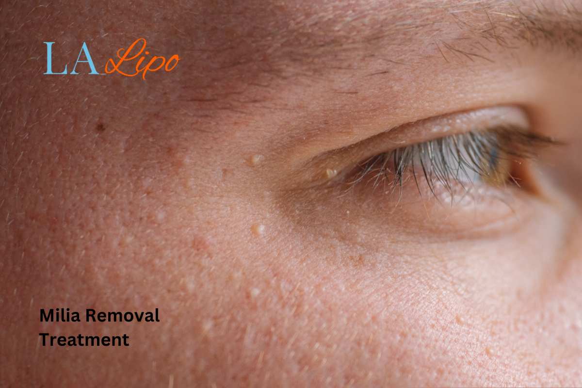 Cryopen Milia Removal: Is It the Easiest and Safest Option Kirkstall?