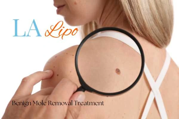 Woman having her inspection of blemish before mole removal Kirkstall