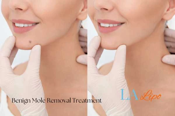 Before and after mole removal Kirkstall treatment