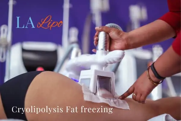 women getting fat freezing Kirkstall
