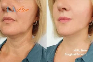 hi-fu for wrinkles Kirkstall before and after results