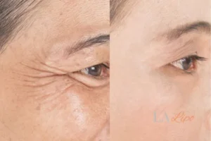 Before and after results of woman - HI-fu wrinkles reduction treatment Kirkstall