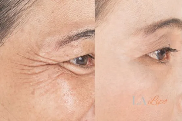 Before and after results of woman - HI-fu wrinkles reduction treatment Kirkstall