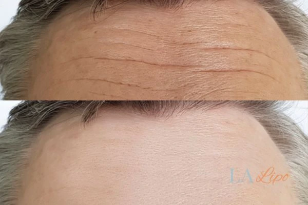 results of HIFU Kirkstall on mans forehead to help reduce lines and wrinkles