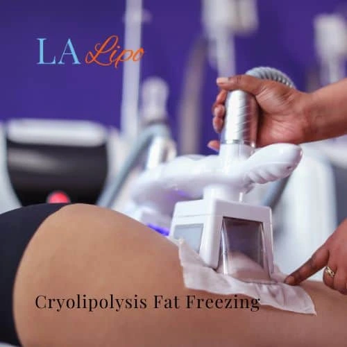 fat freezing - Cryolipolysis Kirkstall