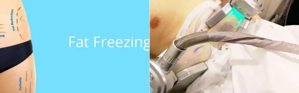 Fat freezing Kirkstall on multiple areas of the body