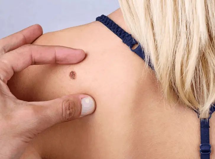 woman having mole removal Kirkstall consultation before treatment.