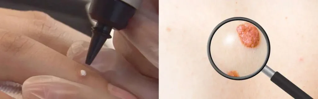 Cryopen for mole removal Kirkstall - speak to our team today!