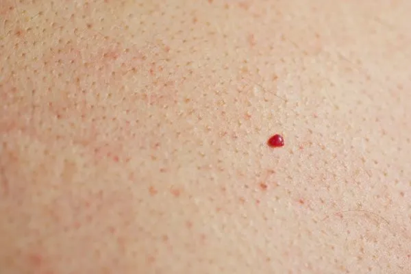 close up of a cherry angioma Kirkstall