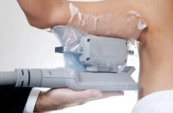 Picture of fat freezing Kirkstall on the upper arms.