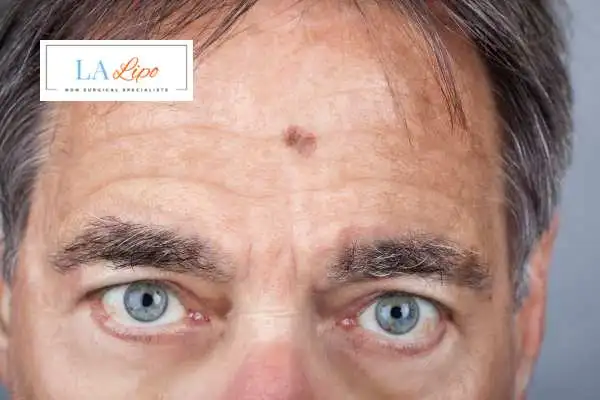 Solar Lentigo Removal Kirkstall image of man with mark on his forehead