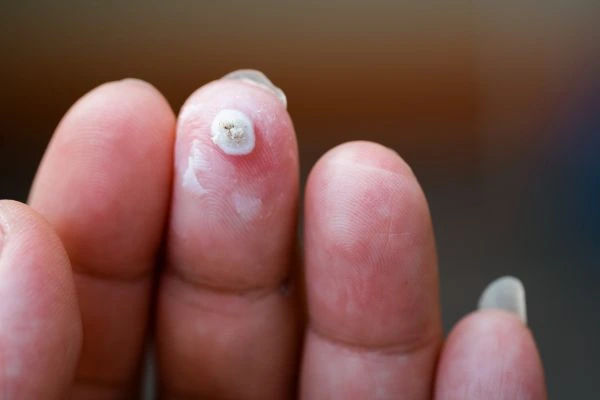 wart on person finger - cryotherapy to treat from LA LIPO Kirkstall