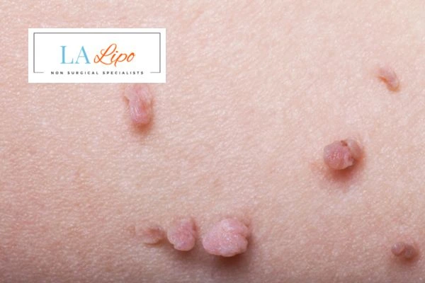 Does cryopen skin tag removal Kirkstall hurt? Find out now call our team today!