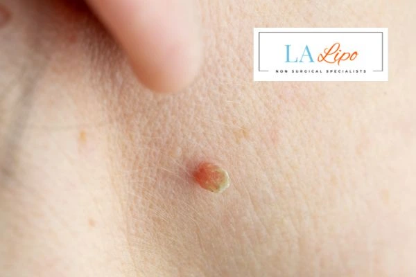 Book skin tag removal Kirkstall today speak to our team now!