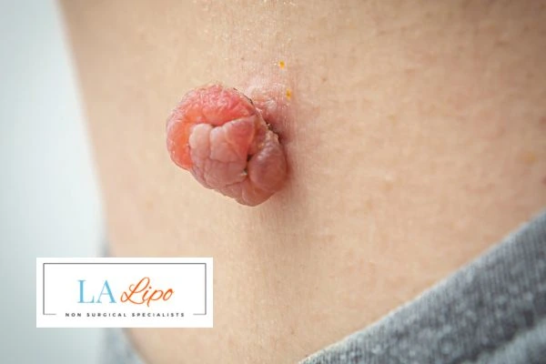 Interested in skin tag removal Kirkstall? Concerned about the pain? Find out more today!