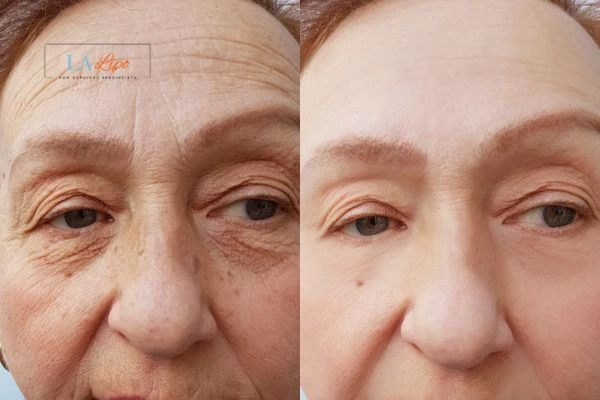 The powerful benefits of Morpheus8 Treatment Kirkstall - Call Our team today!