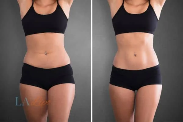 before and after results of non-surgical treatment to help a woman's body image and mental health Kirkstall