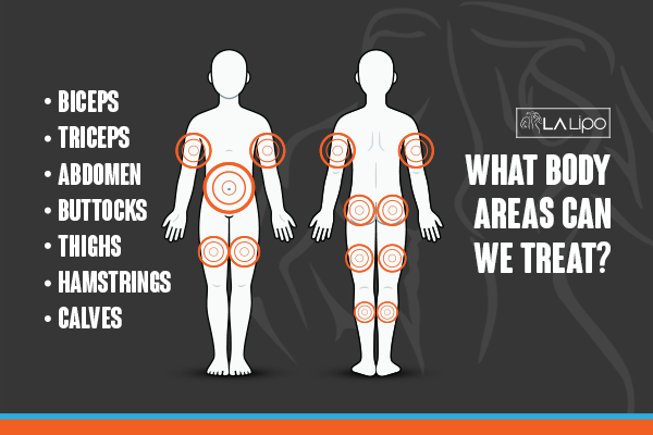 Diagram to show areas you can have LA-EMS Body Sculpting Treatment Kirkstall