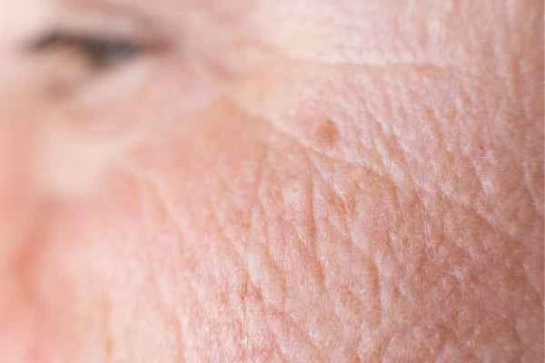 close up picture of a woman's face showing an age spot Kirkstall