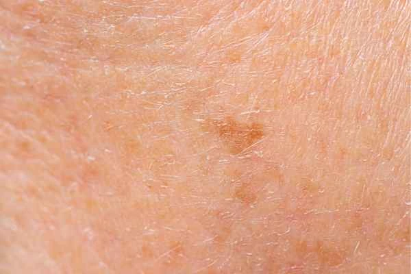 close up picture of age spots Kirkstall