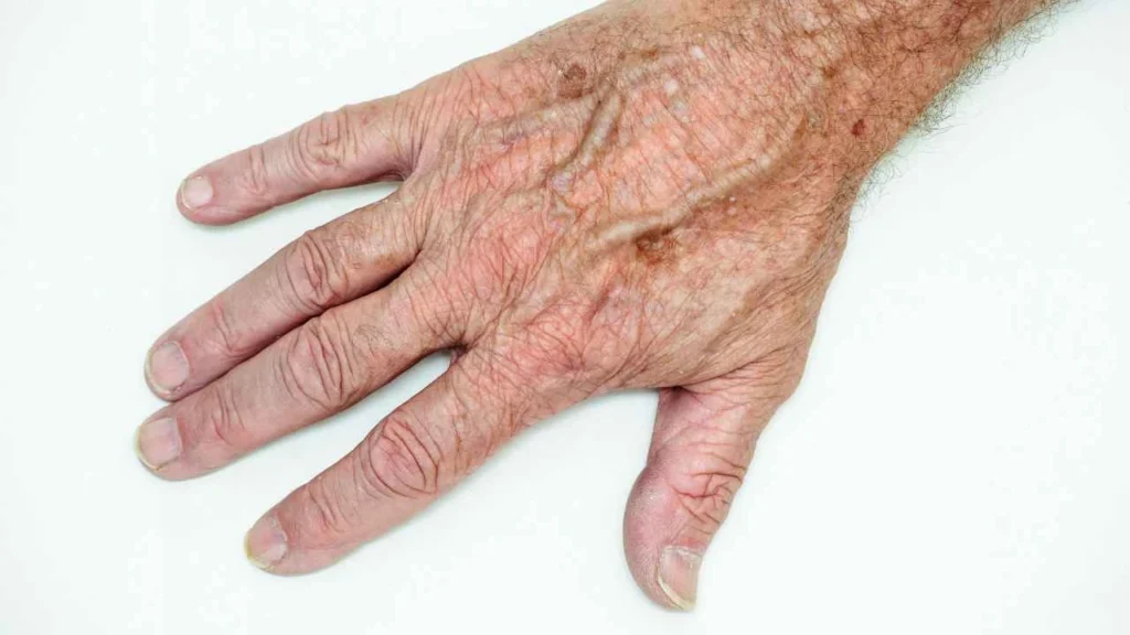 Male hand showing age spot Kirkstall