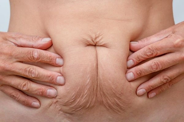 Image of a woman's stomach with loose skin - example of skin tightening Kirkstall options